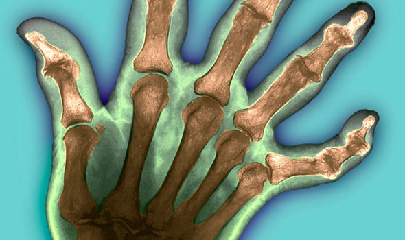 Rheumatoid arthritis - the best fruit and vegetables to reduce joint pain